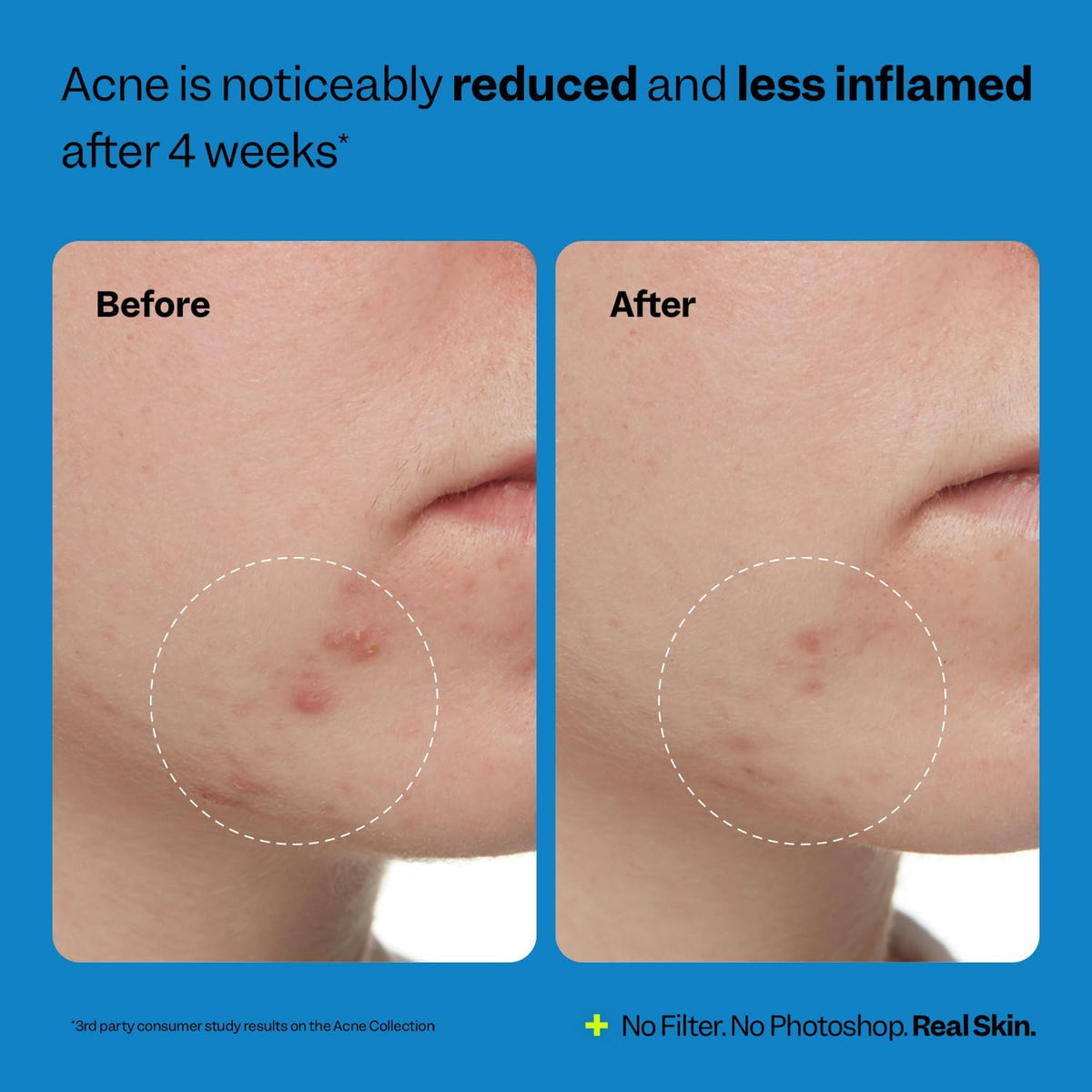 Peach Slices - Acne Exfoliating Toner (4.05 oz) - 2% Salicylic Acid Acne Treatment - Clear & Prevent Breakouts - Lactic & Glycolic Acid - Cucumber - Vegan, Cruelty Free, Korean Skin Care & Beauty