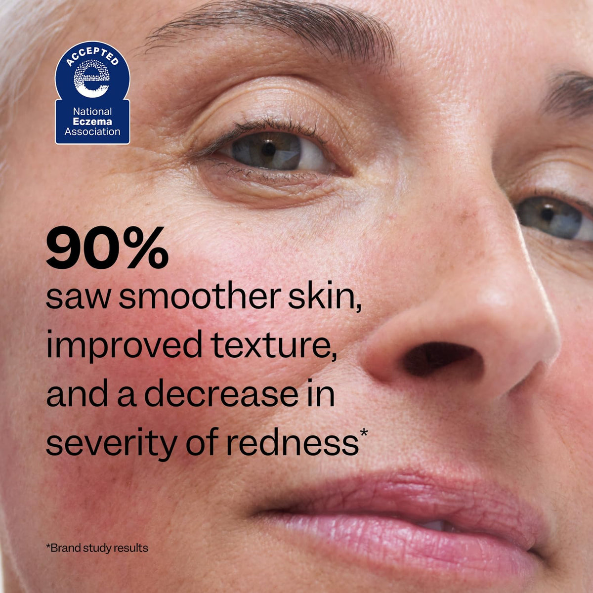 Peach Slices - Redness Relief 10% Azelaic Acid Serum (1.01 oz) - Advanced Skincare - Includes Panthenol, Cica, Algae - Vegan, Cruelty-Free, Korean Skincare & Beauty