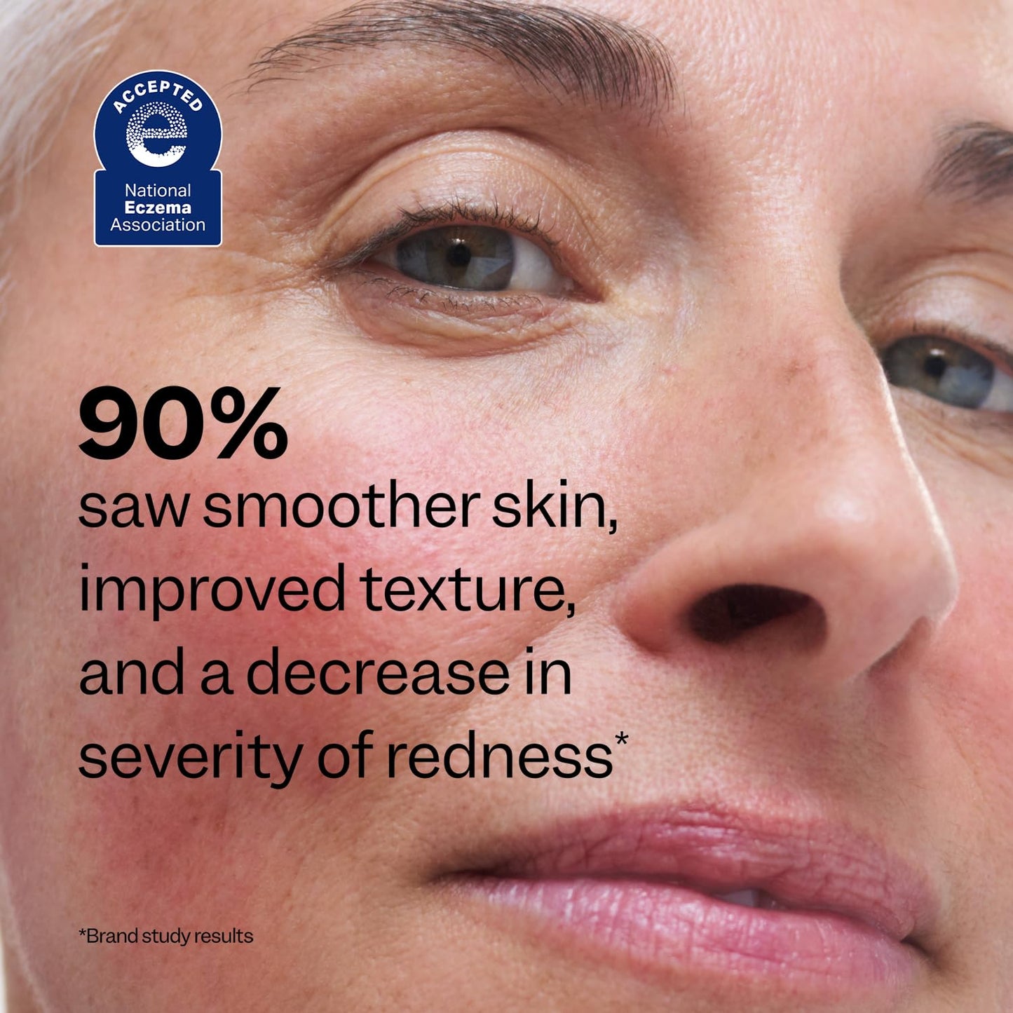 Peach Slices - Redness Relief 10% Azelaic Acid Serum (1.01 oz) - Advanced Skincare - Includes Panthenol, Cica, Algae - Vegan, Cruelty-Free, Korean Skincare & Beauty