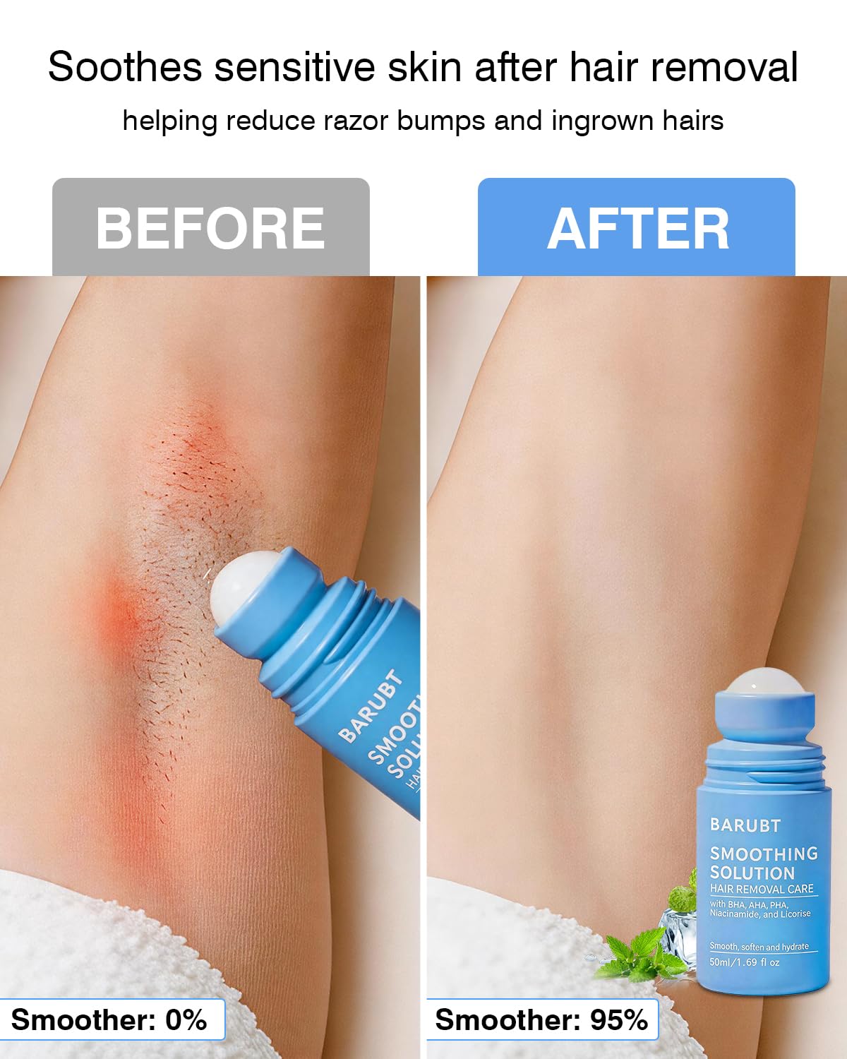 2PC Ingrown Hair Treatment Serum,Soothe redness & Hair Removal Aftercare | Suitable for Bikini Line,Underarms, Legs & Arms | Roller applicator,Cool and breathable,Non-sticky