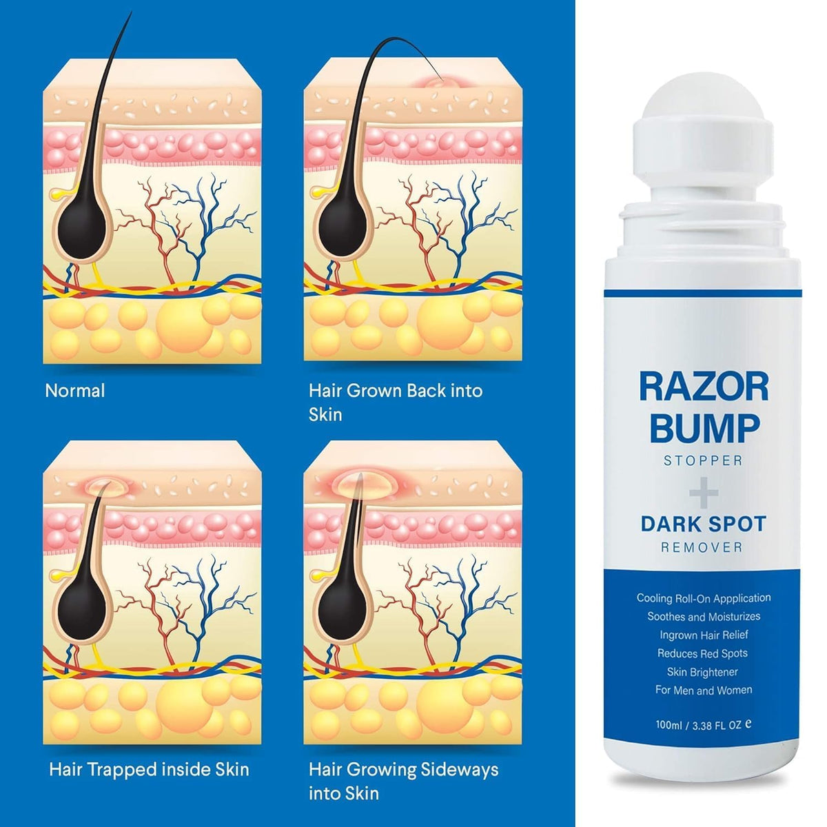 Razor Bump Stopper with Ingrown Hair Treatment: Razor Bumps Treatment for Men and Women, After Shave Solution for Ingrown Hairs and Razor Burns, Roll on Applicator - 3.38 Fl Oz